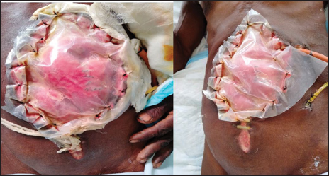 Shows the temporary closure technique for a laparostomy using custom made polypropylene mesh.